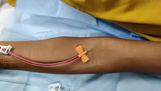 First time Cannulation of AV Fistula [upl. by Tay]