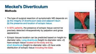 Meckels Diverticulum Wedge Excision vs Segmental Resection Anastomosis [upl. by Yerggoeg688]