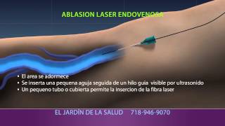 Animation of Ablación Laser Endovenosa [upl. by Animrelliug]