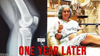 ONE YEAR OF ACL SURGERY RECOVERY [upl. by Eltsyrk418]