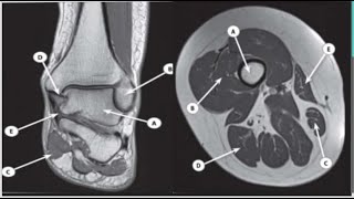 Lower limb Radiology anatomy 2withanswersMRICTxrayfrcrradiopediaquestionstipstricksquiz [upl. by Pazit946]