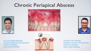 Management of Chronic Periapical Abscess Arabic [upl. by Olegnad669]