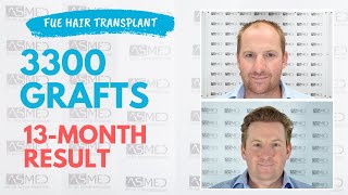 Manual FUE Hair Transplant Before amp After 3300 Grafts 13Month Result  ASMED  Dr Koray Erdogan [upl. by Pufahl]