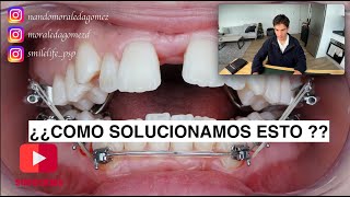 Aprende a SOLUCIONAR y entender CASO complejo de ortodoncia [upl. by Massab]