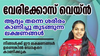 വേരിക്കോസ് വെയ്ൻ കാരണമെന്ത്   Varicose Vein Malayalam varicoseveins [upl. by Newkirk614]