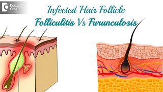 Infected hair follicle What to do Causes Location amp TreatmentDr Rasya Dixit  Doctors Circle [upl. by Granger]