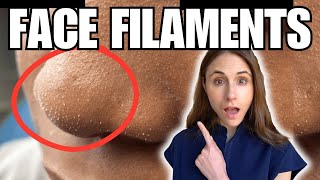 Sebaceous Filaments Vs Demodex Face Mites [upl. by Ellan]