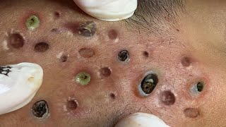 Blackhead Removal With Sac Dep Spa 100074079 [upl. by Akkina]