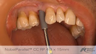 Immediate placement amp provisionalization in maxillary esthetic zone │ NobelGuide amp NobelParallel CC [upl. by Dreyer667]