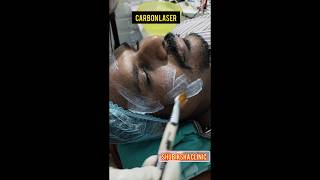 Carbon laser treatmentShubiksha hairampskin care clinicprpgfcbalajinagarkatturtrichy9150923153 [upl. by Nilya]