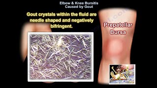 Elbow amp Knee Bursitis Caused By Gout  Everything You Need To Know  Dr Nabil Ebraheim [upl. by Schuman937]