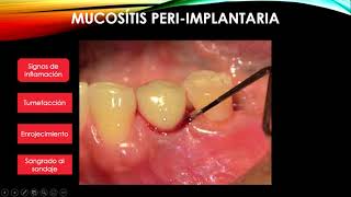 Mucositis y periimplantis [upl. by Alleon810]