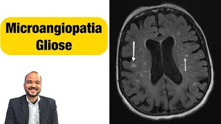 O que é Gliose ou microangiopatia Tem cura Qual tratamento [upl. by Hsenid999]