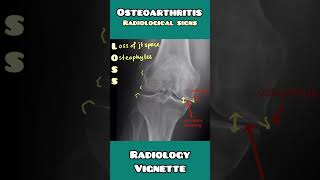 OSTEOARTHRITIS on XRAY radiological signs explained for USMLE NEET PG NCLEX [upl. by Attennot]