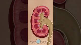 PreOp® 🧬 Advanced Techniques in Kidney Stone Removal preop shorts health 🌐 [upl. by Ainuj]