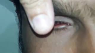 Artificial eye for anophthalmos [upl. by Delastre]