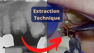 Molar Retained Roots Extraction by Sectioning [upl. by Melissa]