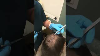 Watch the Stitches come out mybraintumorstory day20aftersurgery [upl. by Berglund539]