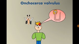 Onchocerca volvulus River blindness عمى الأنهار [upl. by Ibbetson]