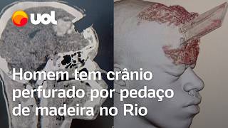 Homem tem crânio perfurado por estaca de madeira e sobrevive após cirurgia no Rio de Janeiro [upl. by Duncan]