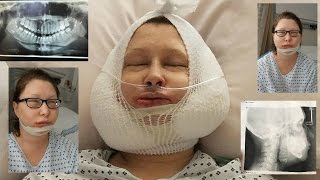 Jaw Surgery Day Vlog  Recovery day 130 [upl. by Kcirredal]