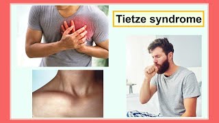 Tietze syndrome [upl. by Orabel]