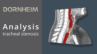 Analysis  tracheal stenosis [upl. by Redliw587]