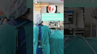 एंडोस्कोपिक टिम्पेनोप्लास्ट ENDOSCOPIC TYMPANOPLASTY endoscopicearsurgerytympanoplastyyoutube [upl. by Watkins]