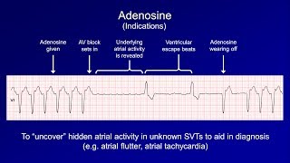 Antiarrhythmics Lesson 6  Digoxin Adenosine Atropine Isoproterenol and Ivabradine [upl. by Ahsi]