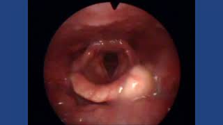 Epiglottic Cyst [upl. by Celinka448]