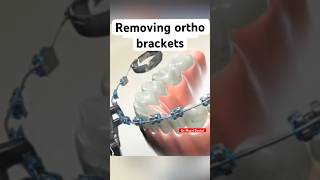 Ortho braces Braces  Orthodonticsmusic youtubeshorts viralvideo [upl. by Erialc761]