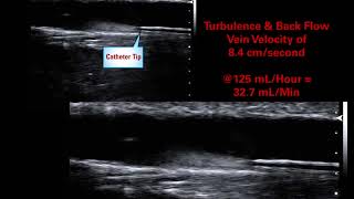 AVA19 Moureau Foor Large Vein High Velocity Hemodilution Case Study 5 [upl. by Ahsratal603]