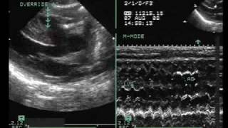 Tetralogy of Fallot with Vertically Oriented PDA [upl. by Dorren]