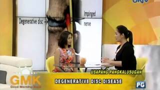 Degenerative Disc Disease [upl. by Sheepshanks41]