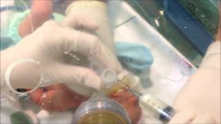 Neonatal Digital Intubation Part 2 [upl. by Eirellam403]