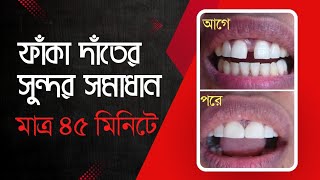 ফাঁকা দাঁতের সহজ ও সুন্দর সমাধান faka dater cikitsha  Diastema Tooth DentalHealthTips [upl. by Vevay203]