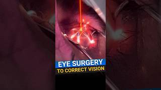 Eye Surgery To Correct Vision [upl. by Allebara]