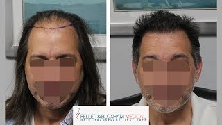 6 Month Hair Transplant Results What to Expect  Feller amp Bloxham Medical  NY NYC Long Island [upl. by Francene]