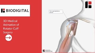 3D Medical Animation of a Rotator Cuff Surgery [upl. by Ydal]