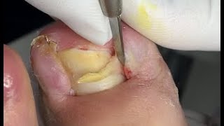 Double ingrown nails treatment [upl. by Pearline]