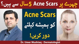 Treatments for ACNE SCARS Kaise Hataye  Acne Scars Removal  How To Remove Acne Scars [upl. by Norit]