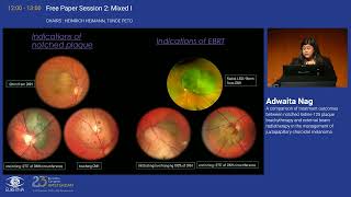 5 A comparison of treatment outcomes between notched Iodine125 plaque brachytherapy and external b [upl. by Retsub]