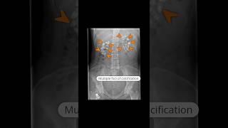 Medullary nephrocalcinosis due to type 1 renal tubular acidosis virlshorts [upl. by Valsimot]