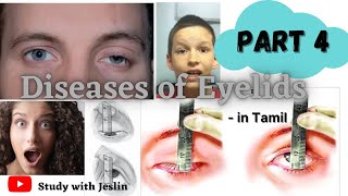 What is Ptosis  Diseases of Eyelids  Types of Ptosis  Study withJeslin [upl. by Jennifer]