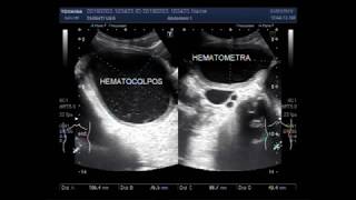 Ultrasound Video showing Hematocolpos with hematometra or Hemometra [upl. by Poppy927]