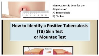 Mantoux test readingmantoux interpretation mantoux testtb skin test indurationTuberculosis [upl. by Eizeerb569]