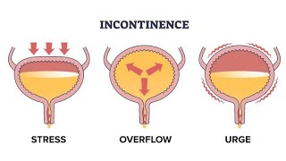 Mnemonic for Storage Irritative Symptoms of lower urinary tract diseases [upl. by Ahsikam]