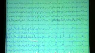 Long term monitored EEG [upl. by Gabby889]