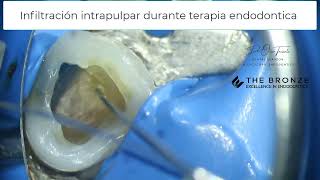 Anestesia intrapulpar durante terapia endodontica [upl. by Tonie]