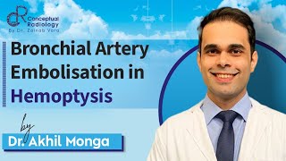 Bronchial Artery Embolisation in Hemoptysis by Dr Akhil Monga ConceptualRadiology [upl. by Wells114]